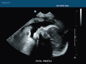 Ultrasonografia płodu — badanie pierwszego rzutu w diagnostyce ciąży
