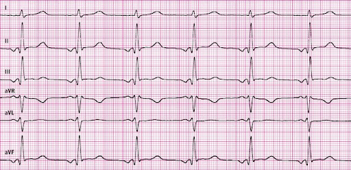 Elektrokardiogram (EKG) – Początek Nowoczesnej Diagnostyki
